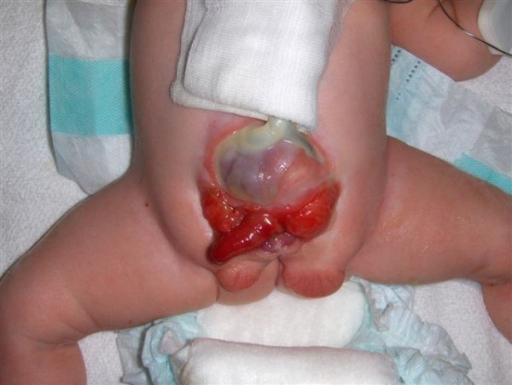 Anus baby born imperforate Dig fucking girl